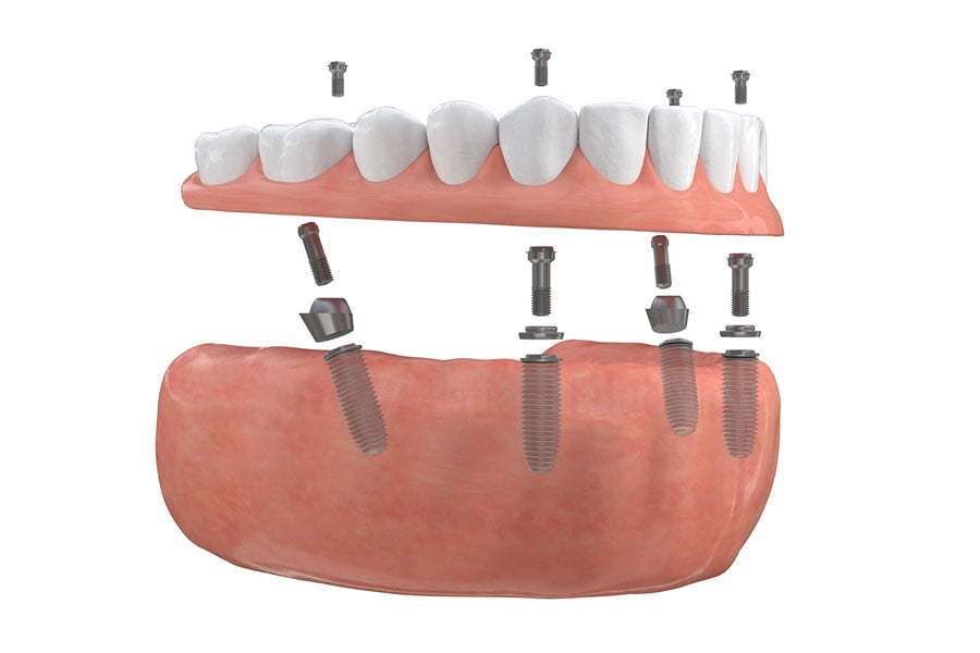 Full Mouth Restoration near Lombard, IL