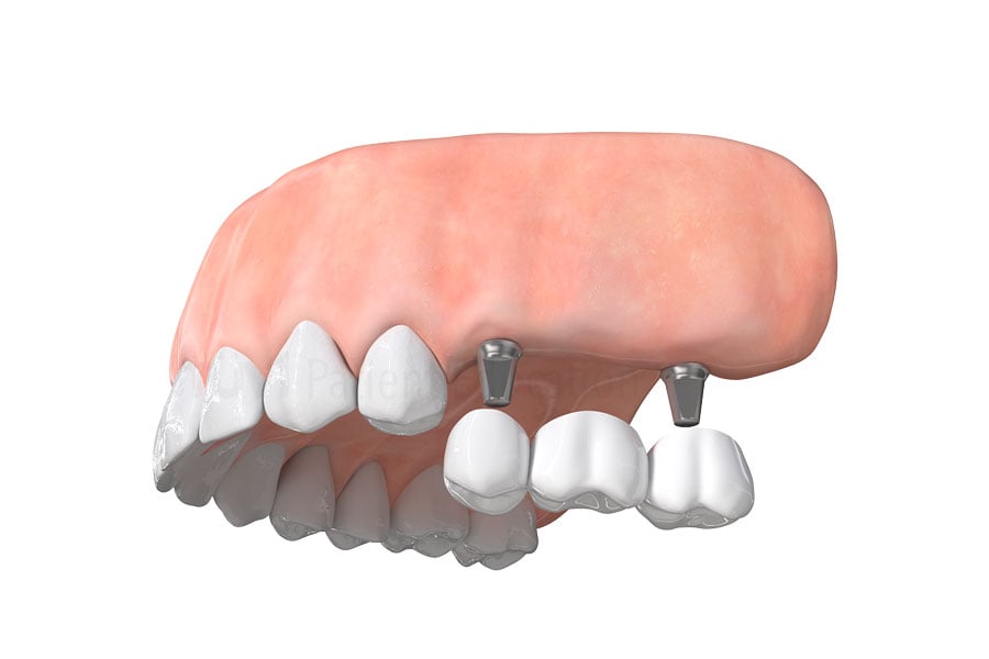 Dental Implant Bridge near Villa Park, IL