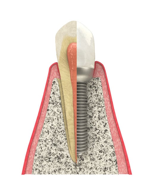 Benefits of Dental Implants near Glen Ellyn, IL