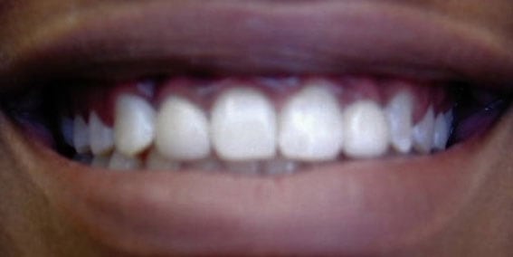 View our patient after photos of their smile changed with peg laterals all porcelain crowns from the dental practice in Lombard, IL. After Photos of Peg Laterals All Porcelain Crowns in Lombard, IL