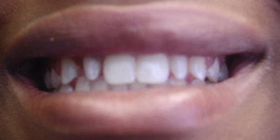 View our patient Before photos of their smile changed with peg laterals all porcelain crowns from the dental practice in Lombard, IL. Before Photos of Peg Laterals All Porcelain Crowns in Lombard, IL