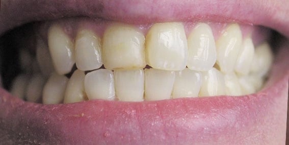 View our patient before photos of their smile changed with veneers from the dental practice in Lombard, IL. Before Photos of Veneers in Lombard, IL