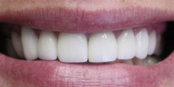 View our patient after photos of their smile changed with all porcelain crowns from the dental practice in Lombard, IL. After Photos of All Porcelain Crowns in Lombard, IL