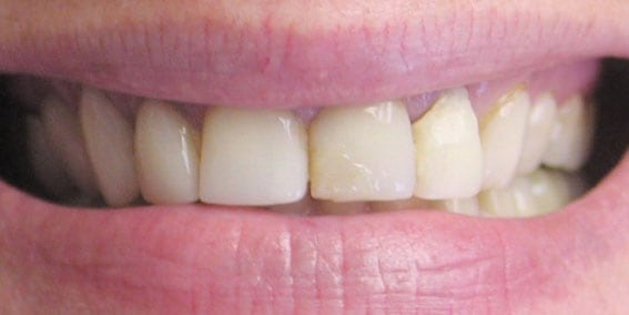View our patient before photos of their smile changed with all porcelain crowns from the dental practice in Lombard, IL. Before Photos of All Porcelain Crowns in Lombard, IL