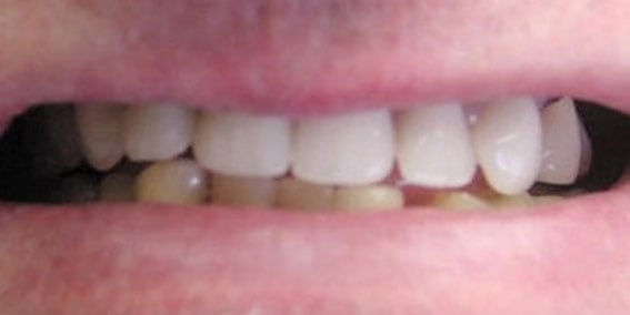 View our patient after photos of their smile changed with implant crowns to gold from the dental practice in Lombard, IL. After Photos of Implant Crowns to Gold in Lombard, IL