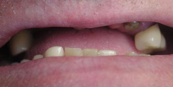 View our patient before photos of their smile changed with implant crowns to gold from the dental practice in Lombard, IL. Before Photos of Implant Crowns to Gold in Lombard, IL