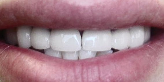 View our patient after photos of their smile changed with porcelain crowns to gold from the dental practice in Lombard, IL. After Photos of Porcelain Crowns to Gold in Lombard, IL