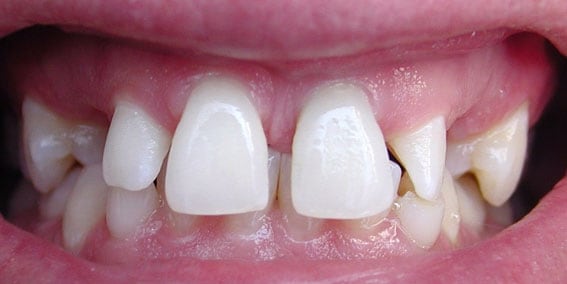 View our patient before photos of their smile changed with porcelain crowns to gold over implants from the dental practice in Lombard, IL. Before Photos of Porcelain Crowns to Gold in Lombard, IL