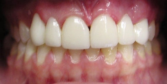 View our patient after photos of their smile changed with all porcelain bridges from the dental practice in Lombard, IL. After Photos of All Porcelain Bridges in Lombard, IL