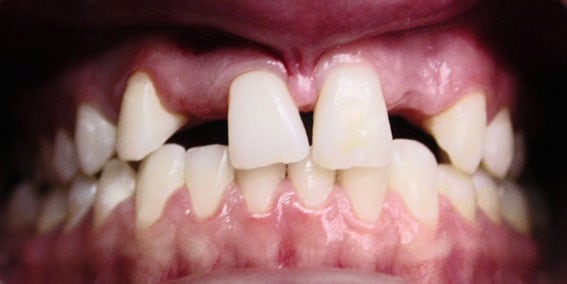 View our patient before photos of their smile changed with all porcelain bridges from the dental practice in Lombard, IL. Before Photos of All Porcelain Bridges in Lombard, IL