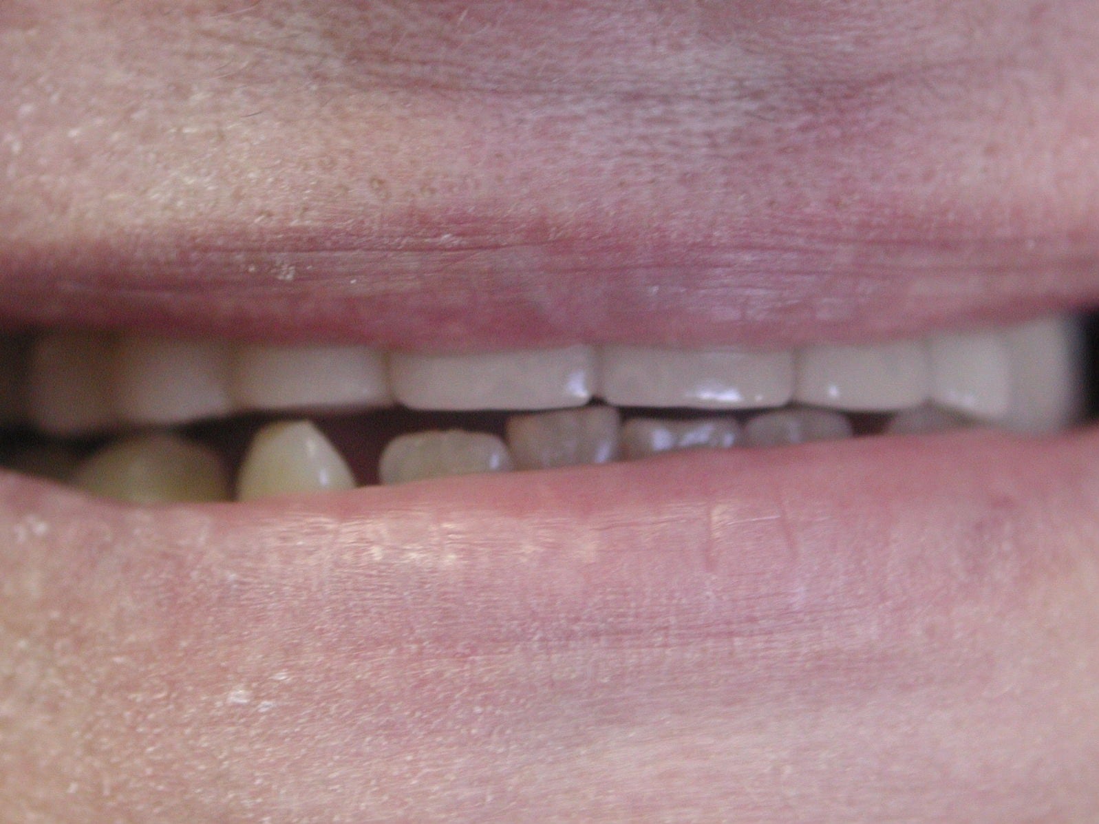 View our patient after photos of their smile changed with fixed bridges over implants from the dental practice in Lombard, IL. After Photos of Fixed Bridges Over Implants in Lombard, IL