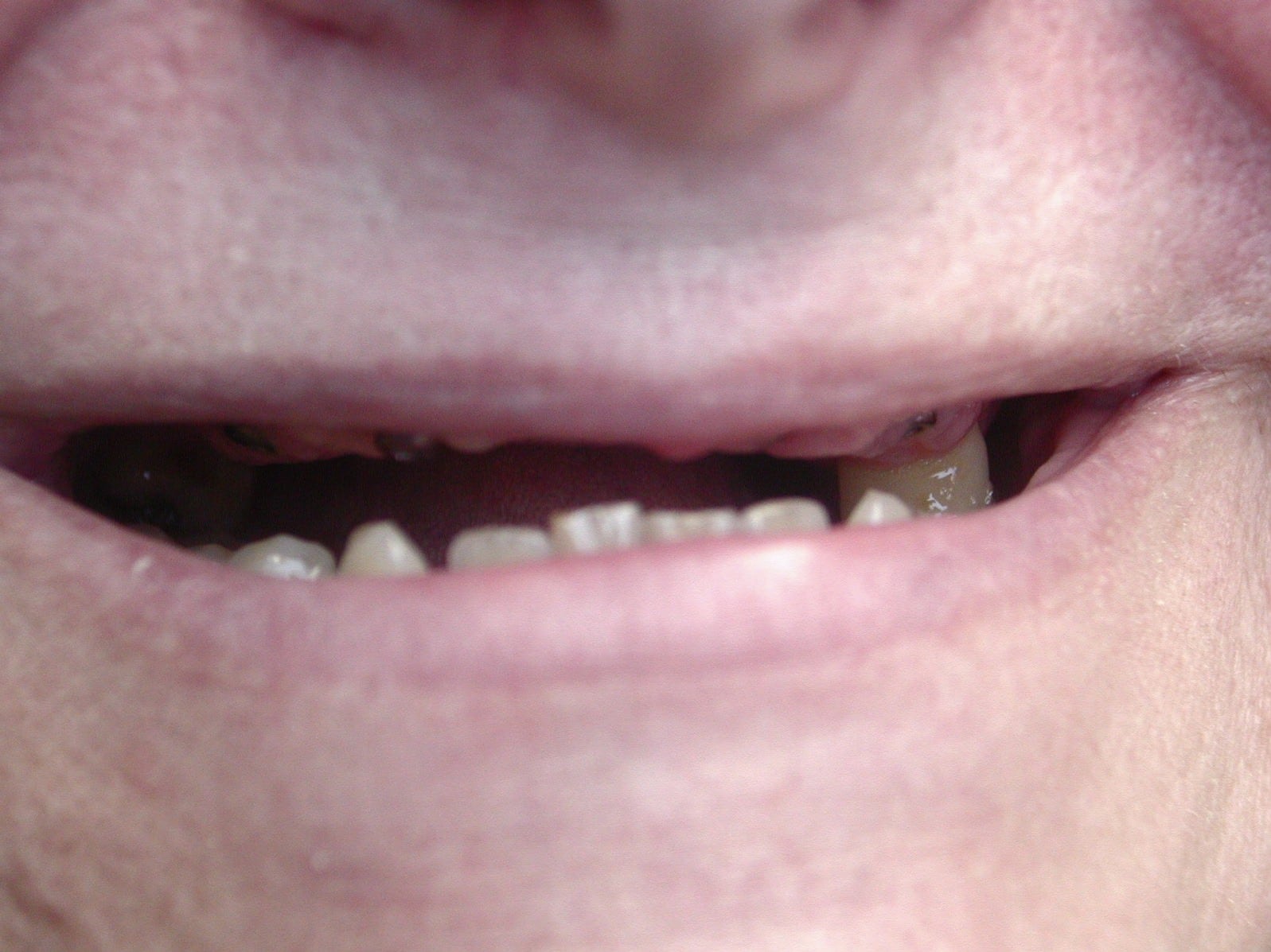 View our patient before photos of their smile changed with fixed bridges over implants from the dental practice in Lombard, IL. Before Photos of Fixed Bridges Over Implants in Lombard, IL